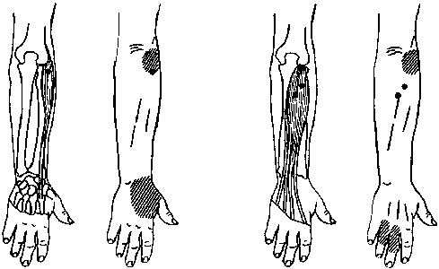 triggerpoints die pijn kunnen veroorzaken in de vingers, de hand en de buitenkant van de elleboog