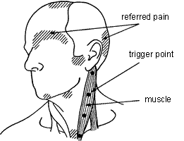 tekening van triggerpoints en pijnpatroon